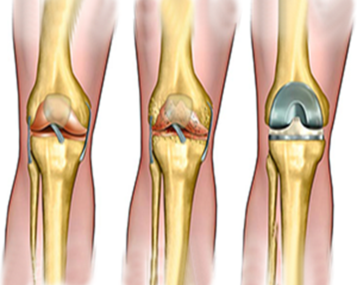 TOTAL KNEE REPLACEMENT