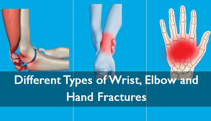 The Different Types of Wrist, Elbow and Hand Fractures
