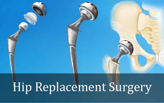 hip replacement surgery